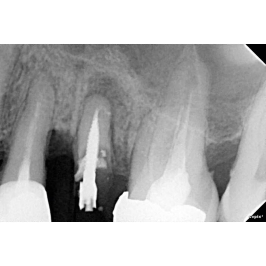 acteon-sopix-2-inside-rvg-sensor-digitales-r-ntgen image 5